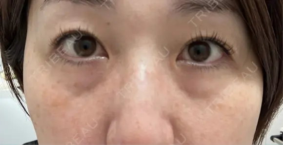 クマ治療 / 下まぶたの脂肪取り ROOTS Clinic BEFORE メイン用