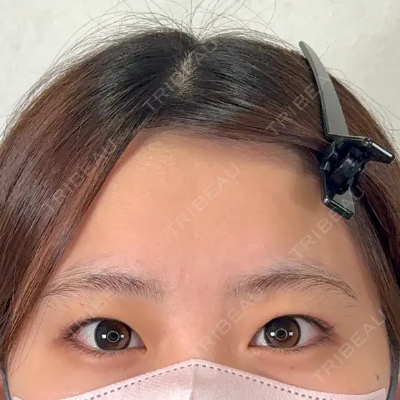二重埋没 / 上まぶたの脂肪取り アリエル美容クリニック 横浜院 BEFORE メイン用