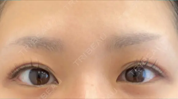 二重埋没 / 自然癒着法 eクリニック 岡山院 BEFORE メイン用