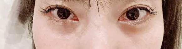 ヒアルロン酸注入（涙袋） ネビュラクリニック 東京錦糸町院 BEFORE メイン用