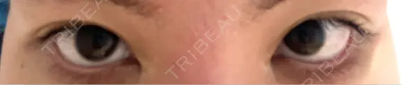 目尻切開 / タレ目形成・グラマラスライン（切開） / 目尻靭帯移動 エターナル美容クリニック BEFORE メイン用