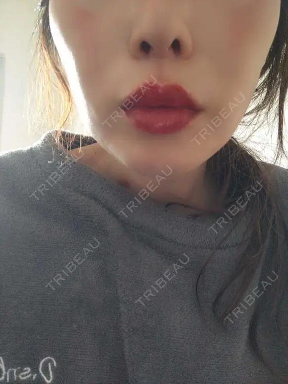 糸リフト A CLINIC（エークリニック） 大阪院 BEFORE メイン用