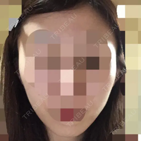 骨切り（あご） / 骨削り（エラ） / 骨削り（頬） ボンディ美容整形外科（旧リオン整形外科） BEFORE メイン用