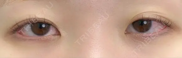 二重切開 / 目頭切開 eクリニック 大阪院 BEFORE メイン用