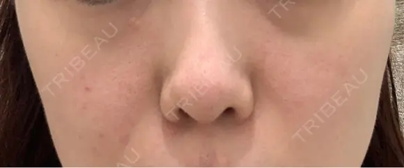 肌育注射（ジュベルックなど） / その他（肌） ゆきスキンクリニック 東池袋 BEFORE メイン用