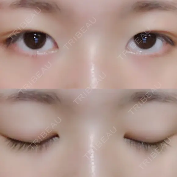 二重埋没 / 眼瞼下垂（切開） アリナガ美容外科 BEFORE メイン用