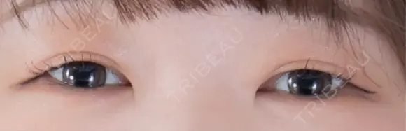 二重埋没 東京イセアクリニック BEFORE メイン用