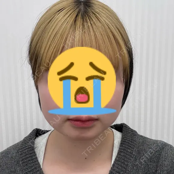 ボトックス（エラ・小顔） / 脂肪溶解注射（顔） / ボトックス（肩） TCB東京中央美容外科 長野院 BEFORE メイン用