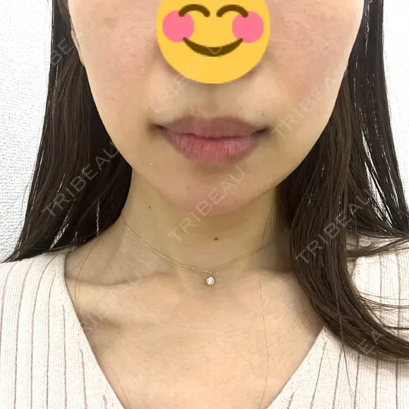 RF（高周波）たるみ治療 TUNE CLINIC【チューンクリニック】 BEFORE メイン用