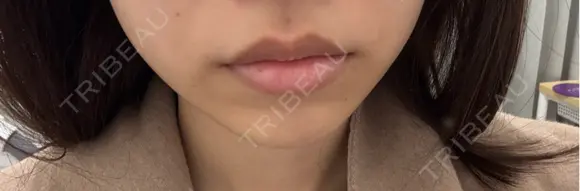 ボトックス（口角） DMTC CLINIC 日本橋院 BEFORE メイン用