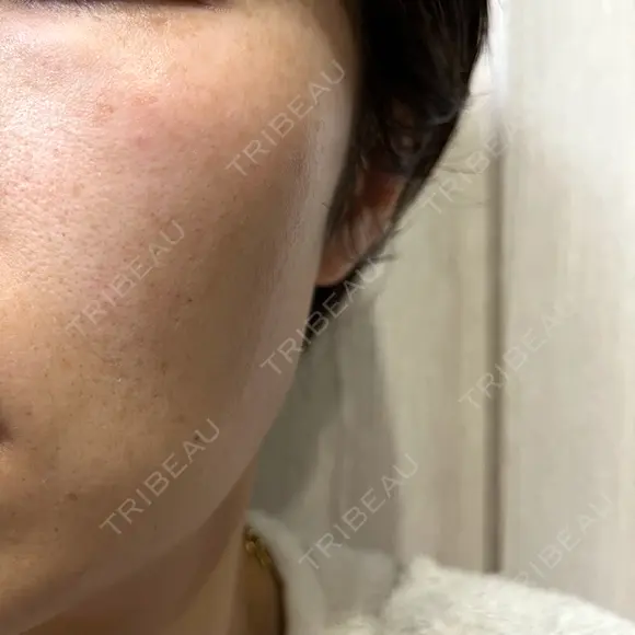 イオン導入 / ピーリング（ハリ・ツヤ） / ルメッカ ルラ美容クリニック 名古屋栄院 / ルラスキンクリニック 名古屋栄院 BEFORE メイン用