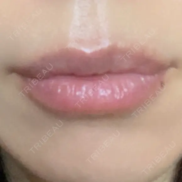 ヒアルロン酸注入（唇） アネシス美容クリニック BEFORE メイン用