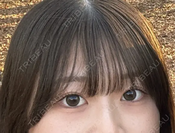 クマ治療 / 下まぶたの脂肪取り / ボトックス（エラ・小顔） / ボトックス（肩） TCB東京中央美容外科 大宮西口院 BEFORE メイン用