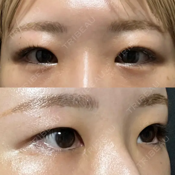 二重埋没 / ヒアルロン酸注入（涙袋） EMMO FACE CLINIC 東京三田院 BEFORE メイン用