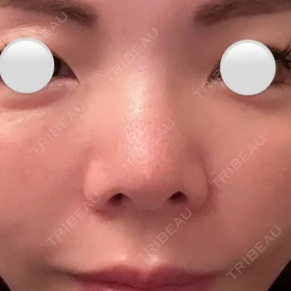 隆鼻術 / 鼻尖形成（切開） / 小鼻縮小（切開） / 軟骨移植 / 眉間プロテーゼ / 鼻修正 / 鼻尖縮小 / 鼻柱下降・鼻唇角形成（猫手術） / その他（鼻） グローバルビューティークリニック 銀座院 BEFORE メイン用