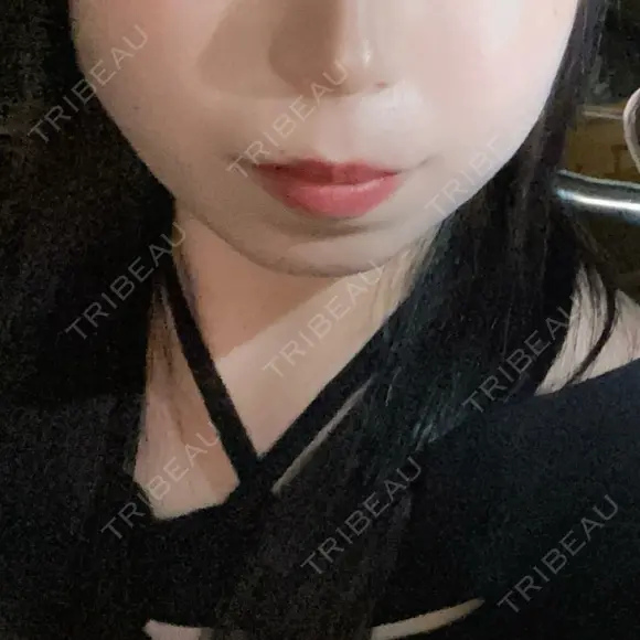 ヒアルロン酸注入（あご） / ボトックス（エラ・小顔） ルラ美容クリニック 名古屋本院 BEFORE メイン用