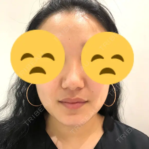 鼻尖形成（切開） / 鼻中隔延長（切開） / その他（鼻） / 軟骨移植 / ボトックス（あご） / ヒアルロン酸注入（あご） / ボトックス（エラ・小顔） / ボトックス（肩） エートップ美容整形外科 BEFORE メイン用