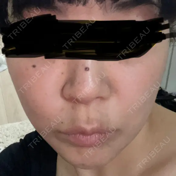 鼻尖形成（切開） / 小鼻縮小（切開） / 軟骨移植 ASTRA BEAUTY CLINIC BEFORE メイン用