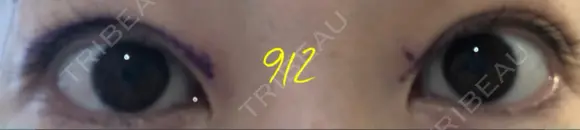 二重切開 / 上まぶたたるみ取り / 目元修正 神野美容形成外科クリニック BEFORE メイン用