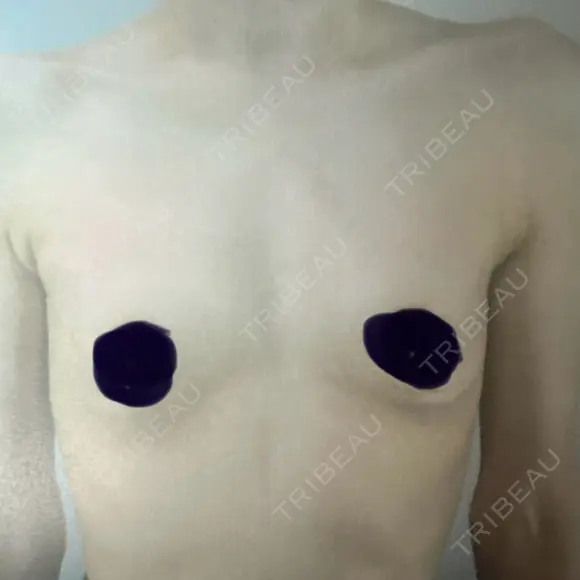 豊胸（シリコンバッグ） 共立美容外科 仙台院 BEFORE メイン用