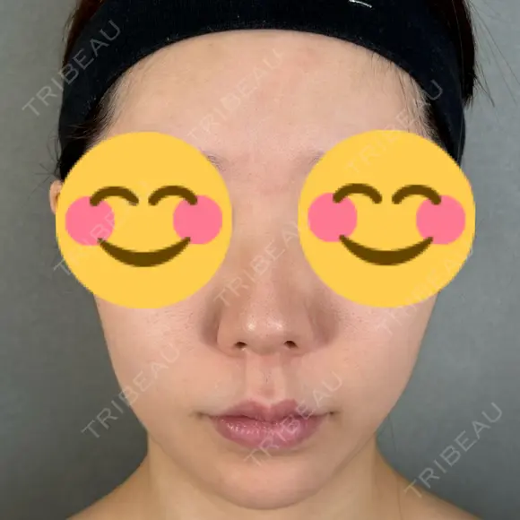 鼻尖形成（切開） / 人中短縮 / 鼻孔縁挙上 / その他（鼻） アリエル美容クリニック 大宮院 BEFORE メイン用