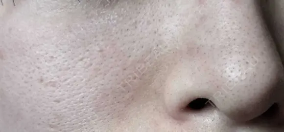 毛穴洗浄（ハイドラフェイシャルなど） / ピコフラクショナルレーザー（毛穴・ニキビ跡） 心斎橋KT美容クリニック BEFORE メイン用