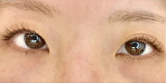 二重埋没 オアシス美容外科 BEFORE メイン用