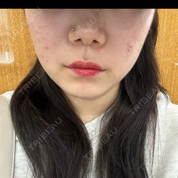 その他（肌） / ピーリング（ニキビ・毛穴） / ポテンツァ HAAB×DREAM BEAUTY CLINIC 大阪梅田院 BEFORE メイン用