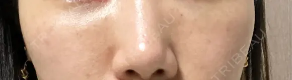 ヒアルロン酸注入（頬） DMTC CLINIC 渋谷院 BEFORE メイン用