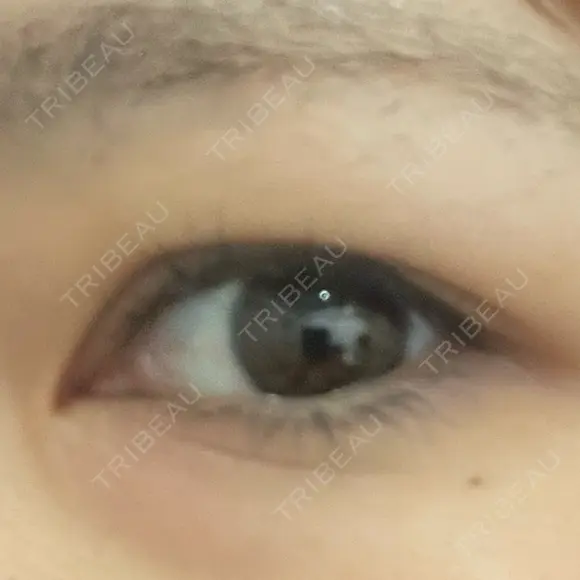 二重埋没 / 自然癒着法 Brandnew Beauty Clinic BEFORE メイン用