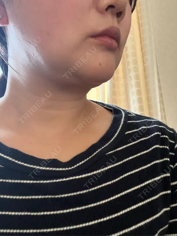 その他（輪郭） YAYOI CLINIC BEFORE メイン用