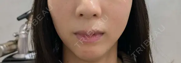 その他（肌） / ポテンツァ UB CLINIC 横浜 BEFORE メイン用