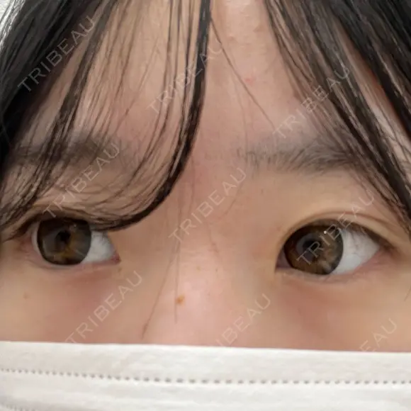 二重切開 / 目頭切開 / 眼瞼下垂（切開） / ヒアルロン酸注入（涙袋） 東京シンデレラ美容外科 池袋院 BEFORE メイン用