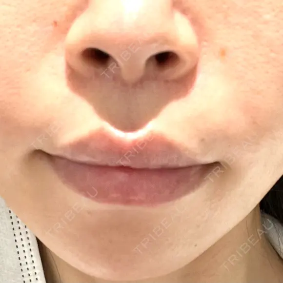 肌ヒアルロン酸注入（たるみ・シワ改善） MEMOTO CLINIC 名古屋 BEFORE メイン用