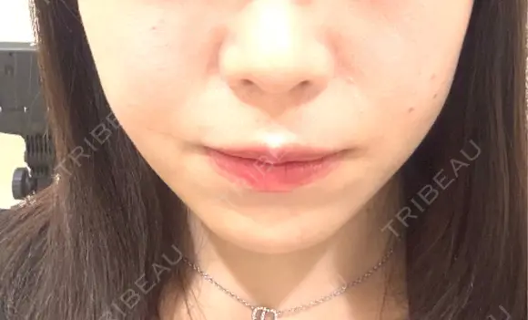 ボトックス（エラ・小顔） / ヒアルロン酸注入（鼻翼基部） KAGA CLINIC BEFORE メイン用