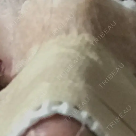 隆鼻術 / 鼻中隔延長（切開） 牧野皮膚科形成外科内科医院 美容外科・形成外科・抗加齢医学外来 BEFORE メイン用