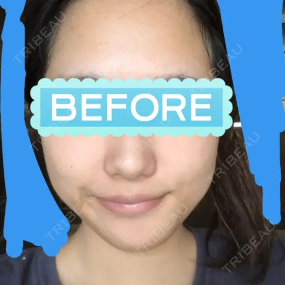 目頭切開 / バッカルファット除去 / 脂肪吸引（顔） / 目尻切開 / タレ目形成・グラマラスライン（切開） / その他（目元） RG整形外科（旧リオン整形外科） BEFORE メイン用