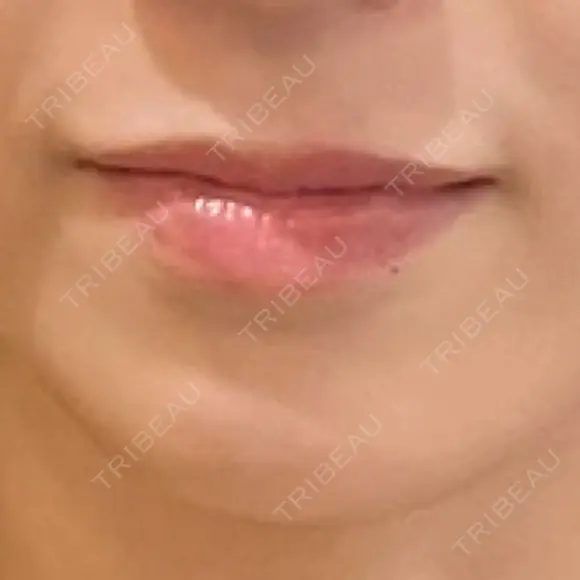 ヒアルロン酸注入（唇） Wi Clinic （ウィ クリニック）心斎橋院 BEFORE メイン用