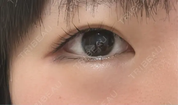 二重切開 聖心美容クリニック 広島院 BEFORE メイン用