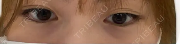 ヒアルロン酸注入（涙袋） 共立美容外科 広島院 BEFORE メイン用