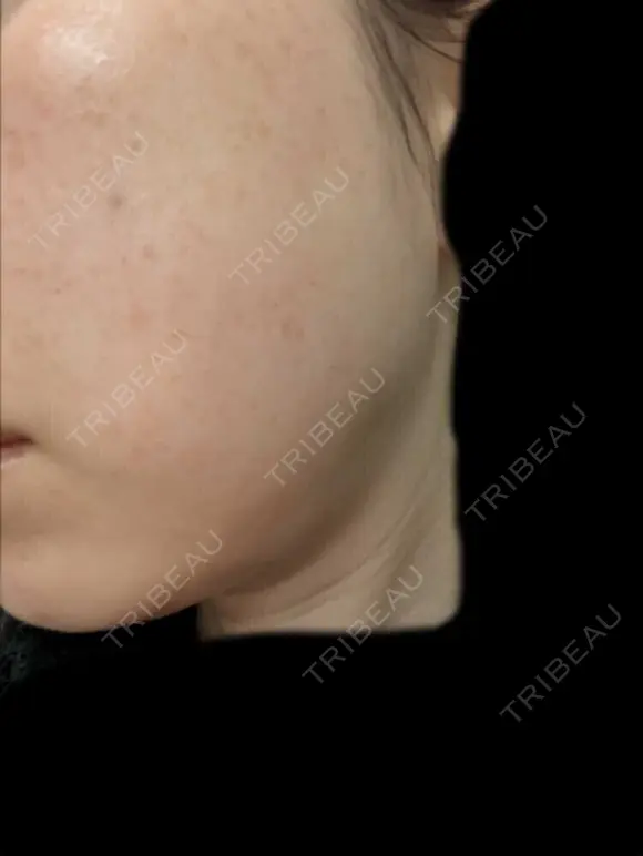 ルビーレーザー AZ BEAUTY CLINIC BEFORE メイン用