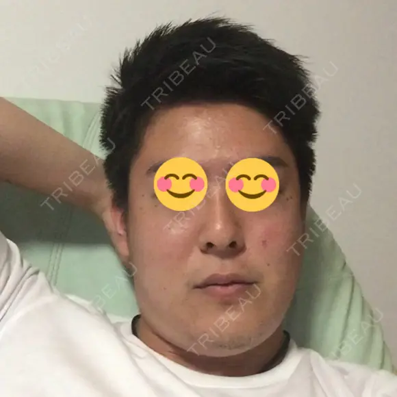 ほくろ・いぼ切除（肌） 吉田美容形成クリニック BEFORE メイン用