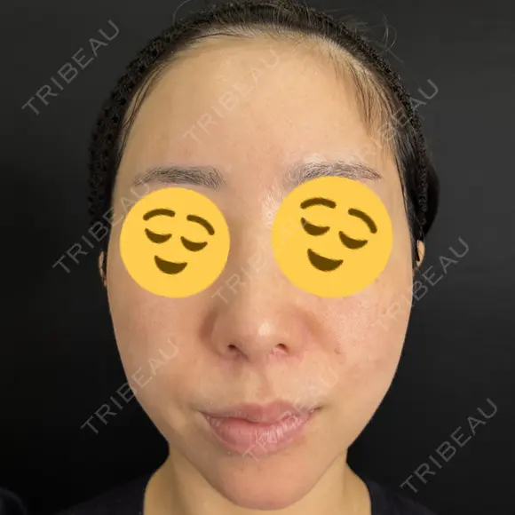 ヒアルロン酸注入（あご） / ヒアルロン酸注入（額） / ヒアルロン酸注入（鼻翼基部） 藤・ナチュレ美容クリニック 銀座院 BEFORE メイン用