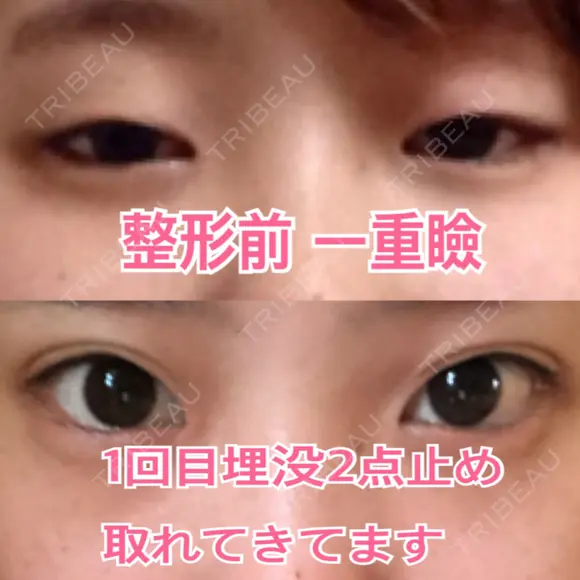 二重埋没 恵聖会クリニック 心斎橋院 BEFORE メイン用