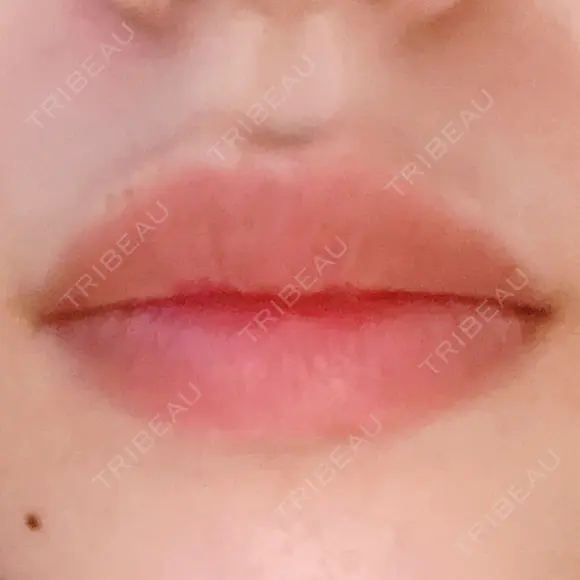 ヒアルロン酸注入（唇） TCB東京中央美容外科 堺院 BEFORE メイン用