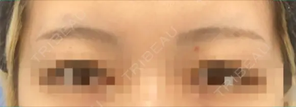 アートメイク除去・修正 表参道メディカルクリニック 新宿院 BEFORE メイン用