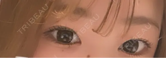 二重埋没 Stand by Beauty Clinic BEFORE メイン用