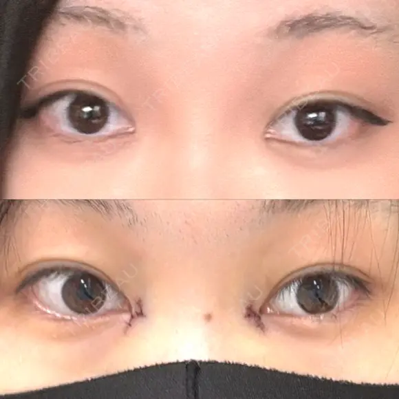 目頭切開 Brandnew Beauty Clinic BEFORE メイン用