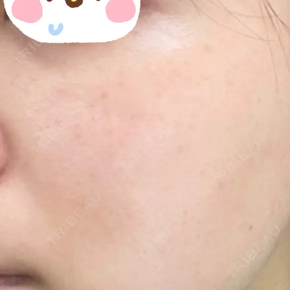 ピーリング（ニキビ・毛穴） / イオン導入 / ルメッカ ルラ美容クリニック 上野院 BEFORE メイン用