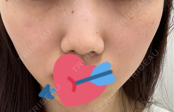 ルメッカ ルラ美容クリニック銀座院 BEFORE メイン用
